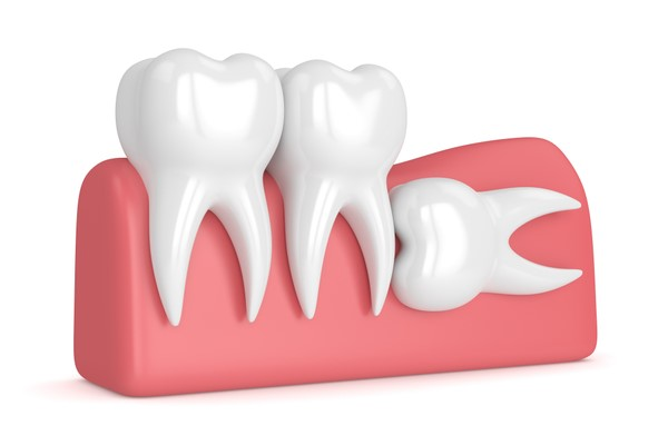 Răng khôn mọc lệch: Những triệu chứng và hậu quả bạn cần chú ý